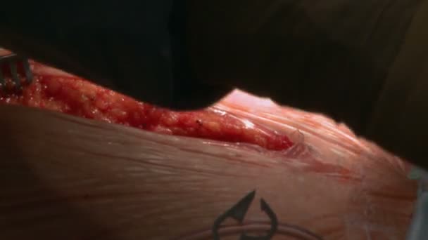 Petto durante un intervento chirurgico a cuore aperto — Video Stock