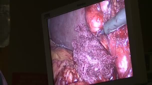 Overhead flat screen for laparoscopic surgery — Stock Video