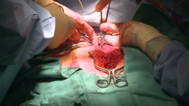 Lekarze pracujący w nacięcie jamy brzusznej — Wideo stockowe