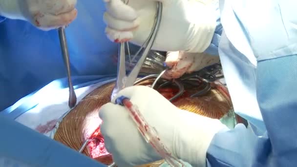 Хирурги выполняют операцию — стоковое видео