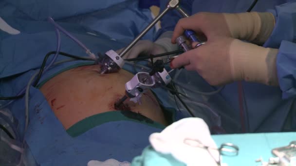 Εκτελεί μια λειτουργία ιατρικών χειρουργών — Αρχείο Βίντεο
