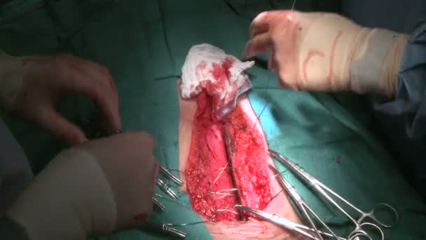 Suturing chest incision — Stock Video