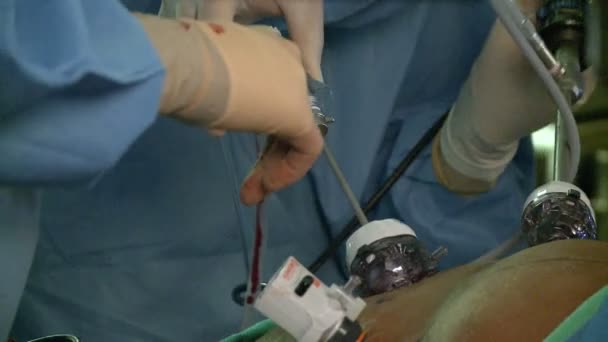 Mains au travail pendant la chirurgie laparascopique — Video