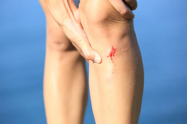 ผู้หญิงที่ถือขาที่บาดเจ็บ — ภาพถ่ายสต็อก