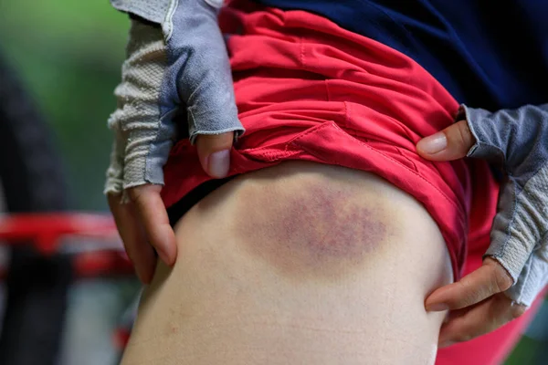 People Bruised Leg Casused Bike Accident — Stock Photo, Image