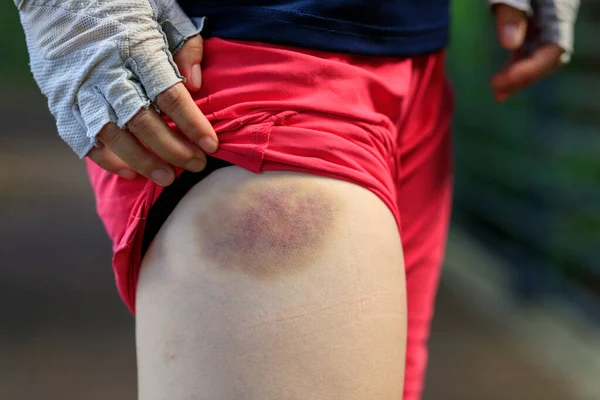 People Bruised Leg Casused Bike Accident — Stock Photo, Image