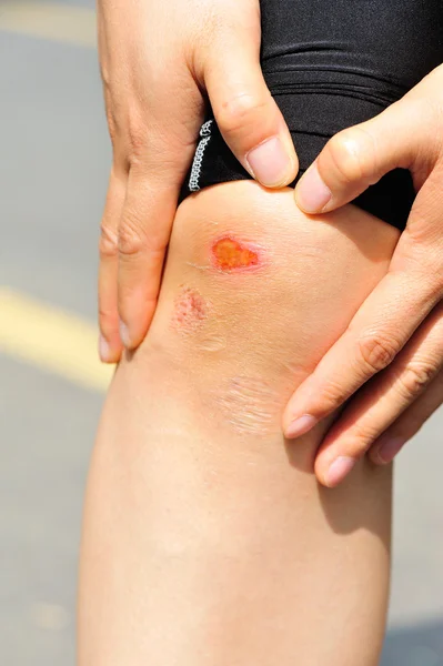 Sportovní zraněné koleno — Stock fotografie
