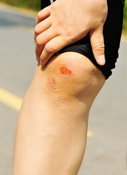 Sports injured knee — Stock Photo, Image