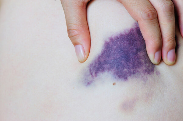 Фиолетовый синяк
