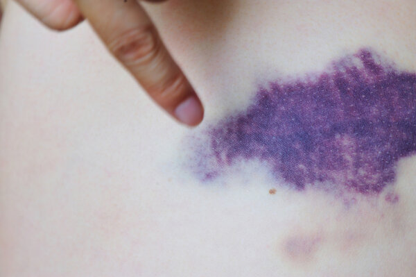 Фиолетовый синяк
