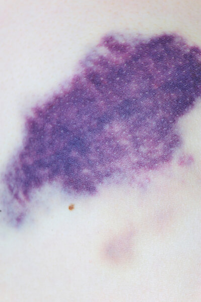 Фиолетовый синяк
