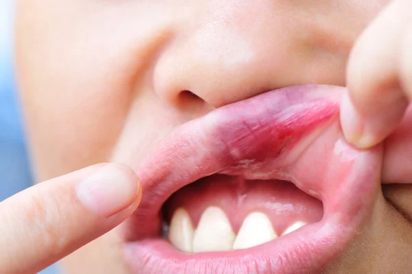 Mulher mostrando lesão labial — Fotografia de Stock