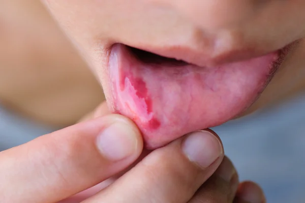 Woman showing lip injury — Stock Photo, Image