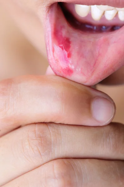 Woman showing lip injury — Stock Photo, Image