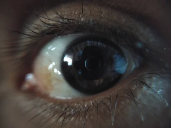 Ojo pardo oscuro con carnosidad avanzando poco a poco, tomado con lente de gran aumento, que permite apreciar algunos detales