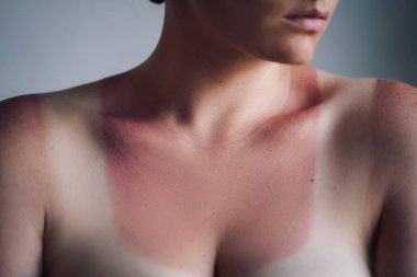 Boynunda güneş yanığı olan kız.