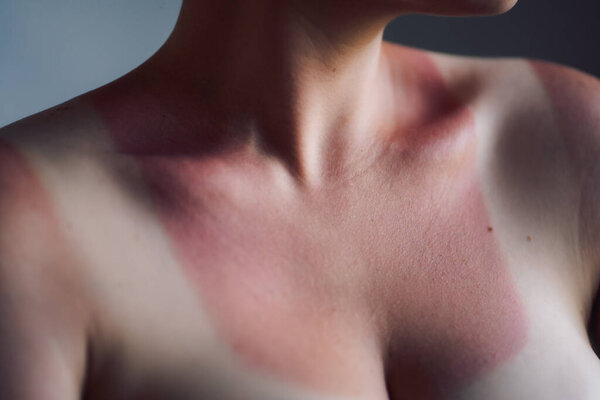 девушка с солнечными ожогами на шее