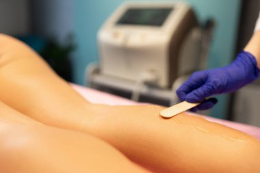 Güzellik uzmanı hastanın bacaklarına lazer tüy dökücü jel uyguluyor.