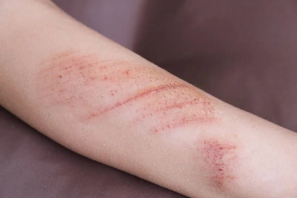 Feridas, arranhões e escoriações na pele da perna de criança. Lesão infantil. — Fotografia de Stock