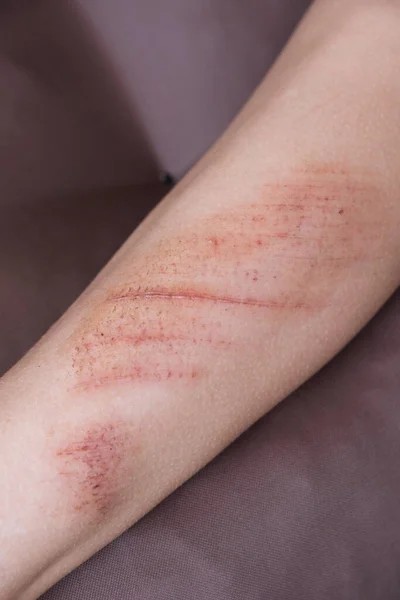 Feridas, arranhões e escoriações na pele da perna de criança. Lesão infantil. — Fotografia de Stock