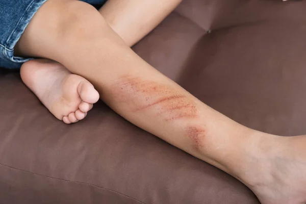 Blessures, éraflures et abrasions sur la peau de la jambe de l'enfant. Blessures d'enfants. — Photo