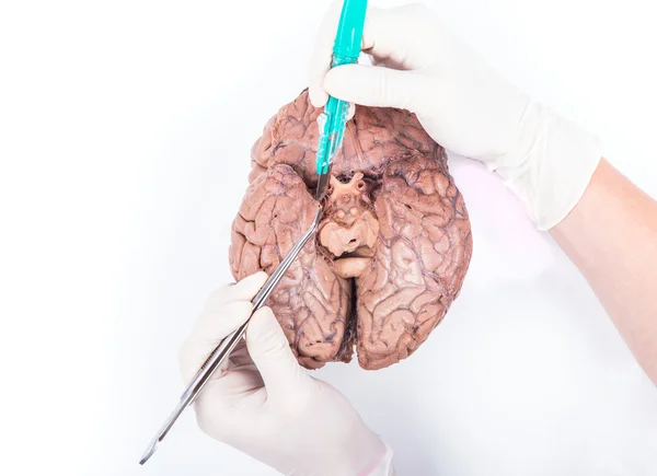 Human brain dissection — Stock Photo, Image