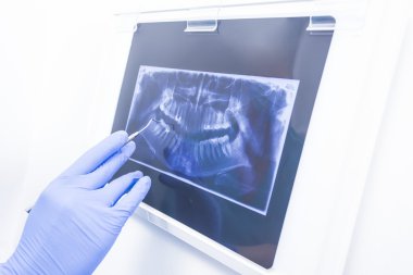 Panoramik xray takma diş görüntü