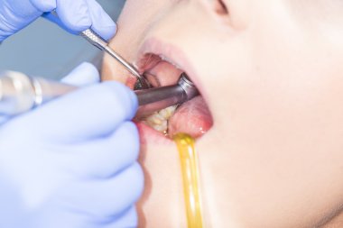 Sağlıksız diş tedavi