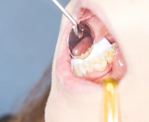 Dentist treating tooth — Stock Photo, Image