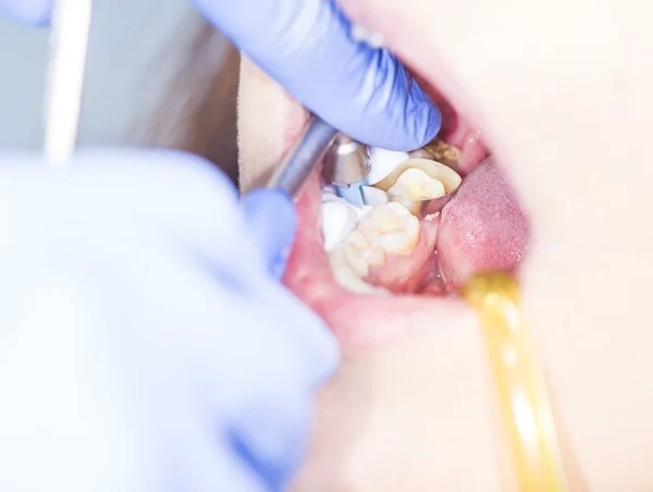 Preparação do dente para enchimento — Fotografia de Stock