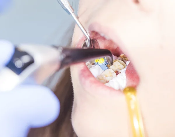 Tandhygien av kvinna — Stockfoto