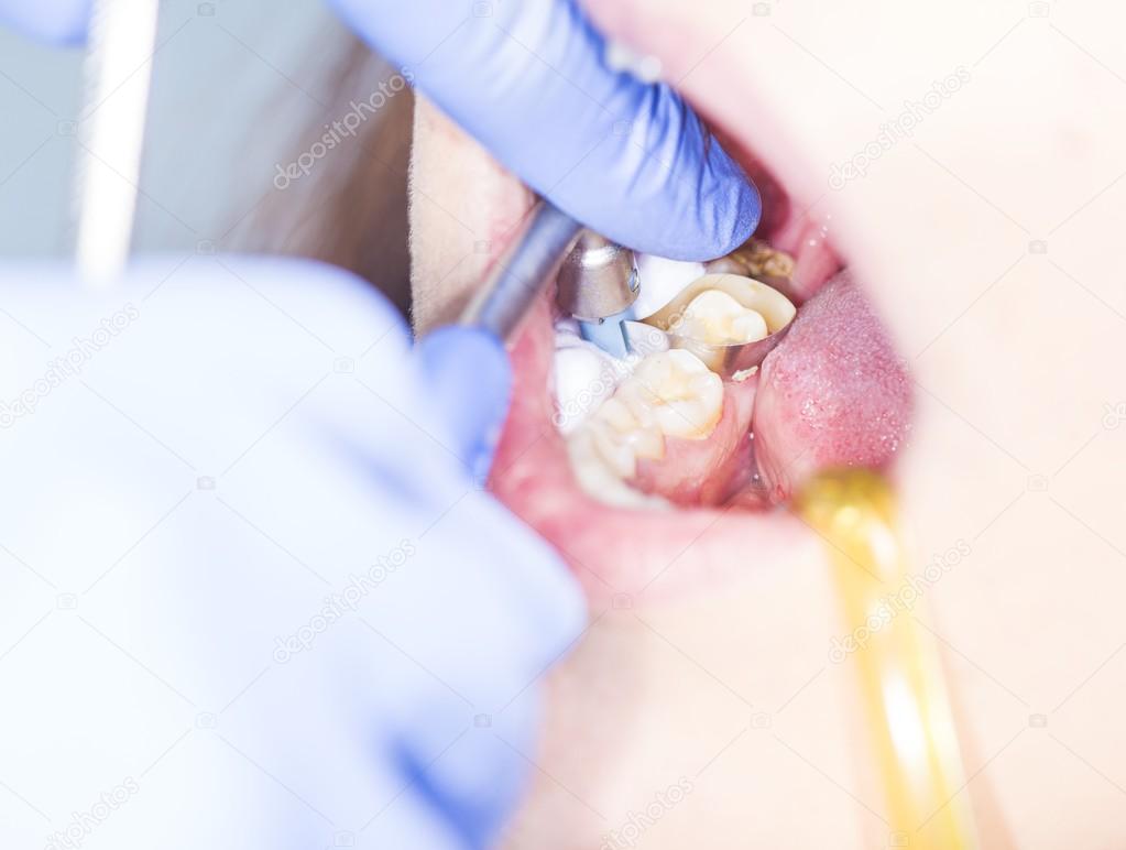 Prepairing tooth for filling