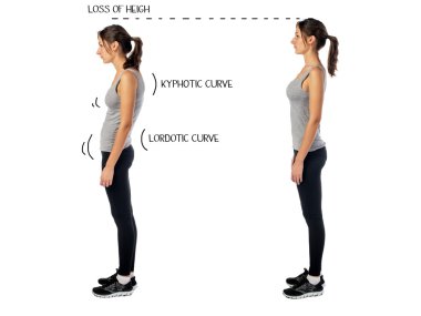 Woman with impaired posture position defect scoliosis and ideal bearing clipart