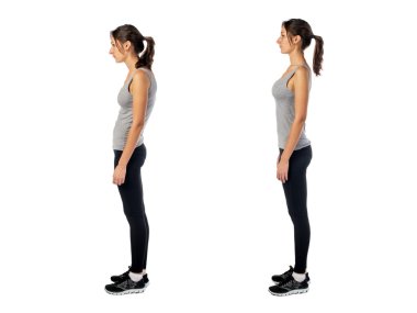 Woman with impaired posture position defect scoliosis and ideal bearing clipart
