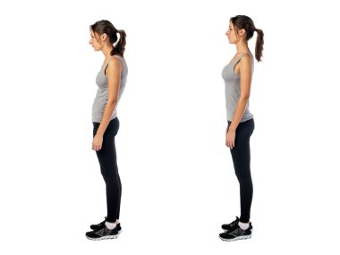 Woman with impaired posture position defect scoliosis and ideal bearing clipart