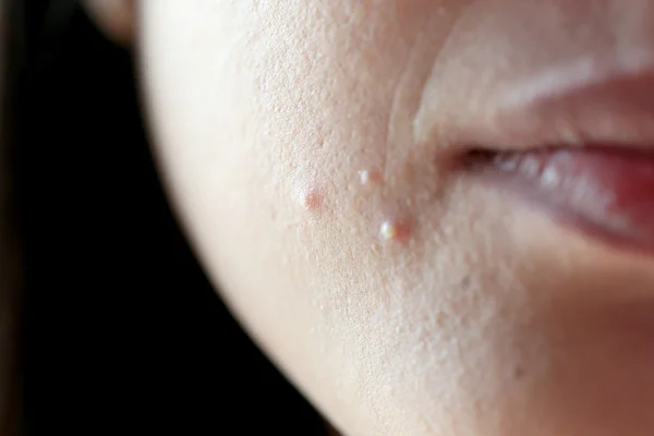 Acne on face. — Stock Photo, Image