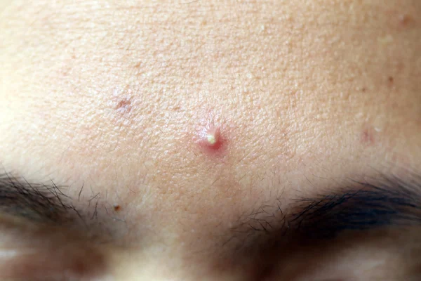 Acne op het gezicht. — Stockfoto