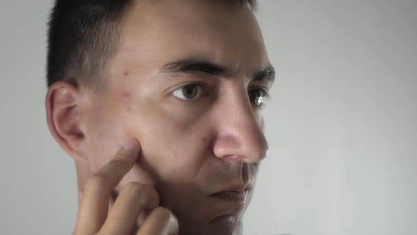 Uomo Adulto Preoccupato Guarda Allo Specchio Esaminando Acne Brufoli Sul — Video Stock