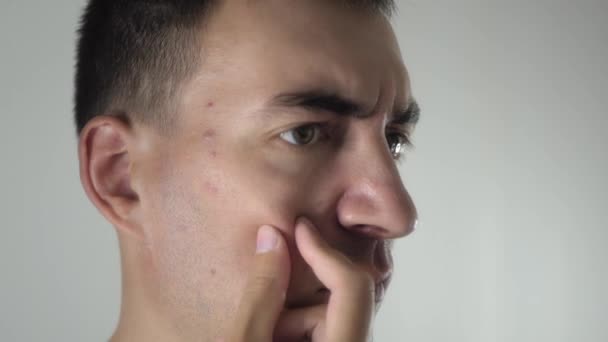 Besorgter Erwachsener Mann Blickt Den Spiegel Und Untersucht Akne Und — Stockvideo