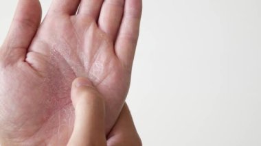 Çatlamış avuç içi derisine yakından bak. Yetişkin birinin avuç içi sorunu. Ellerinde dermatolojik hastalık.