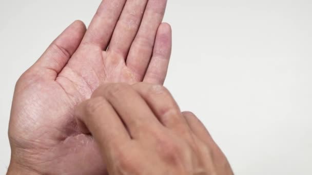 Blick Aus Nächster Nähe Auf Die Rissige Haut Der Handfläche — Stockvideo