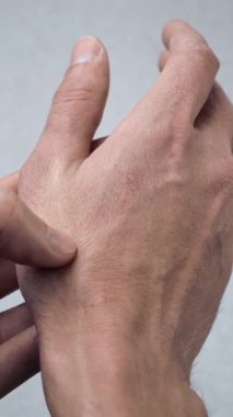 Adam avuç içini kurumuş, çatlamış deriyle tırmalıyor. Hasarlı deri sorunu. Elindeki kuru cilt ya da egzama görüntüsünü kapat. Sağlık hizmeti kavramı.