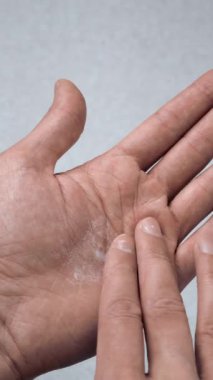 Adam avuç içine krem sürmüş, derisi çatlamış. Hasarlı cilt bakımı sorunu. Elindeki kuru cilt ya da egzama görüntüsünü kapat. Sağlık hizmeti kavramı.