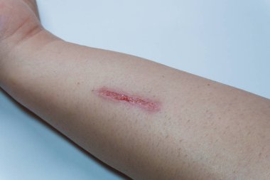 Bir insanın elinde büyük bir kesik, elindeki yaranın iyileşme süreci, bıçak ya da jiletten derin bir kesik, sağlık sigortası tırmalama ameliyatı. Yüksek kalite