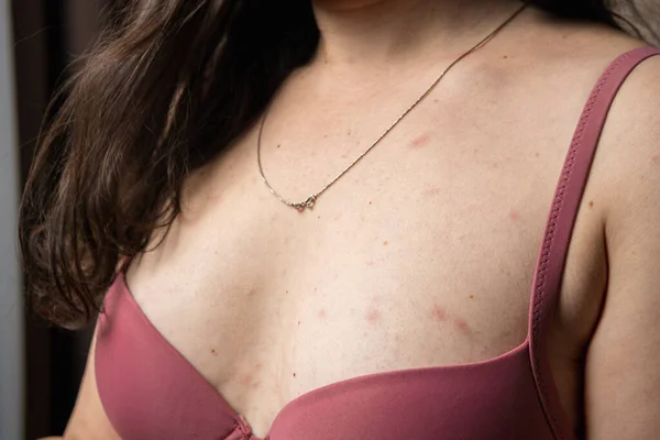Женщины Симптомами Зуда Крапивницы Аллергической Реакции Кожу Красная Сыпь Женском — стоковое фото
