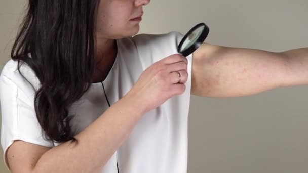 Vrouwen Met Symptomen Van Jeukende Urticaria Allergische Reactie Huid Rode — Stockvideo