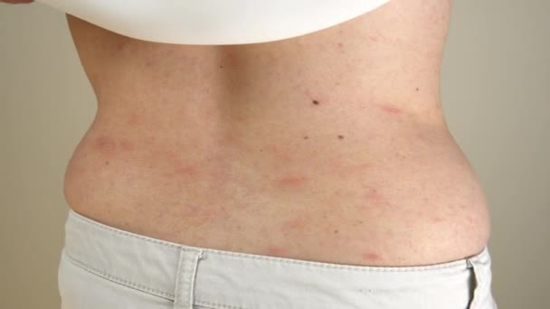 Donne Con Sintomi Orticaria Pruriginosa Reazione Allergica Sulla Pelle Eruzione — Video Stock