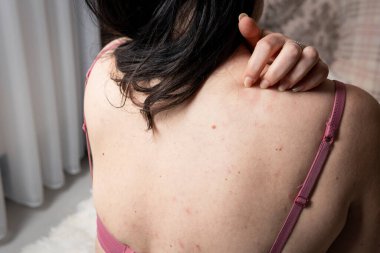 Kaşındırıcı ürtiker semptomları olan kadınlar ya da cildinde alerjik reaksiyon. Kadın vücudunda kızarıklık var. Alerji, deri hastalıkları ve sağlık hizmetleri kavramları.