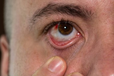 Göz yaralanması, göz damarı patlamış genç bir adam, yorgunluk, kan damarlarında sorunlar.