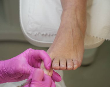 Pembe tıbbi eldiven giyen bir uzmanın ayak tırnağını kontrol ettiği ayak hastalıkları ameliyatına yakın çekim. Ayak bakımı, tırnak tedavisi, hijyen ve sağlık hizmetleri kavramı.